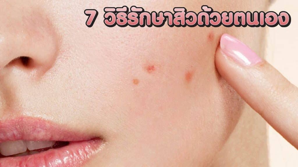 วิธีรักษาสิวด้วยตนเอง