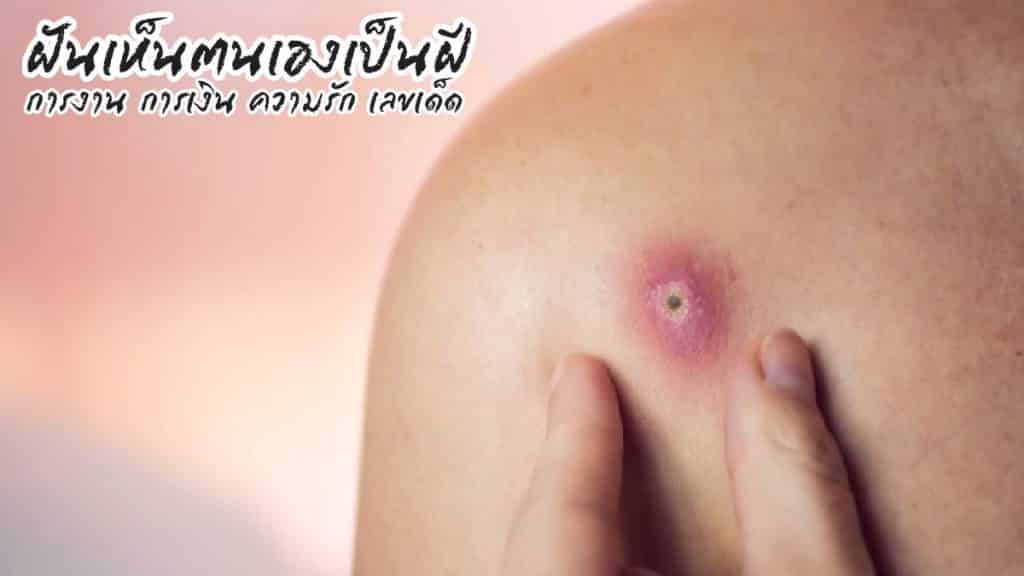 ฝันเห็นตนเองเป็นฝี