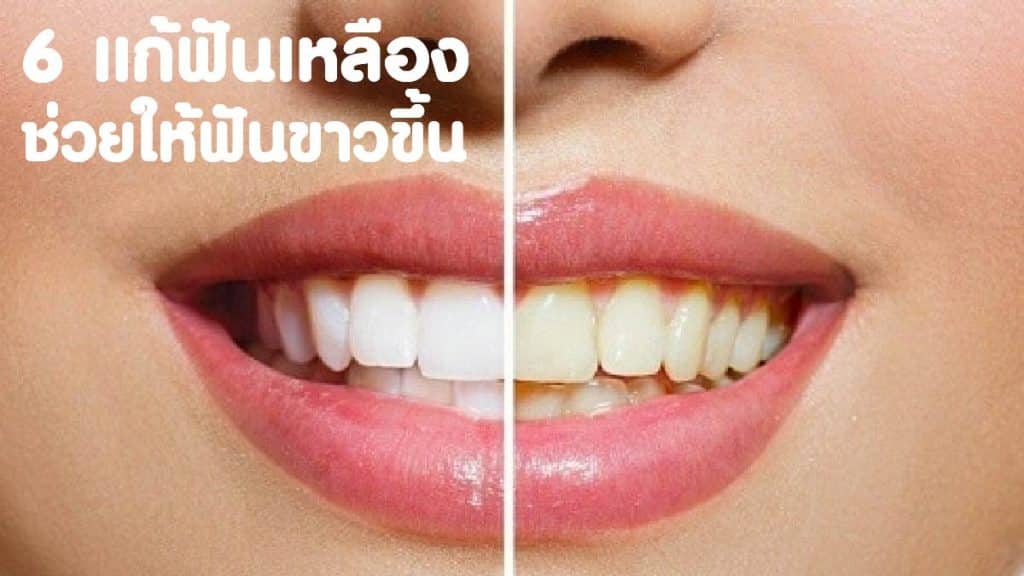วิธีแก้ฟันเหลือง