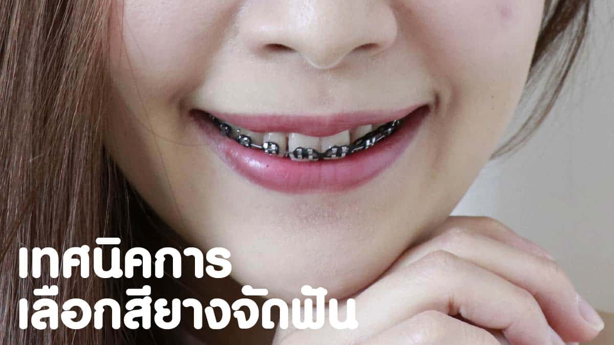 เลือกยางจัดฟันสีอะไรดี