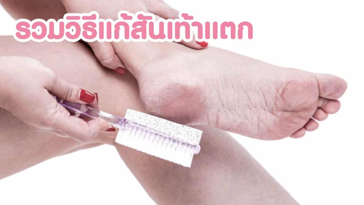 วิธีแก้ส้นเท้าแตก