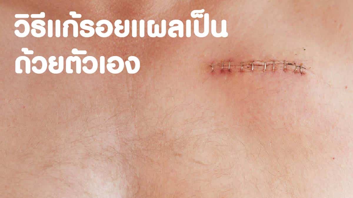วิธีแก้รอบแผลเป็น