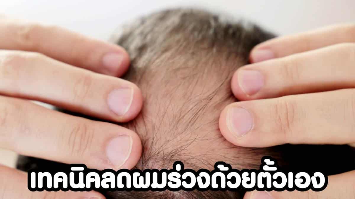 วิธีลดผมร่วง