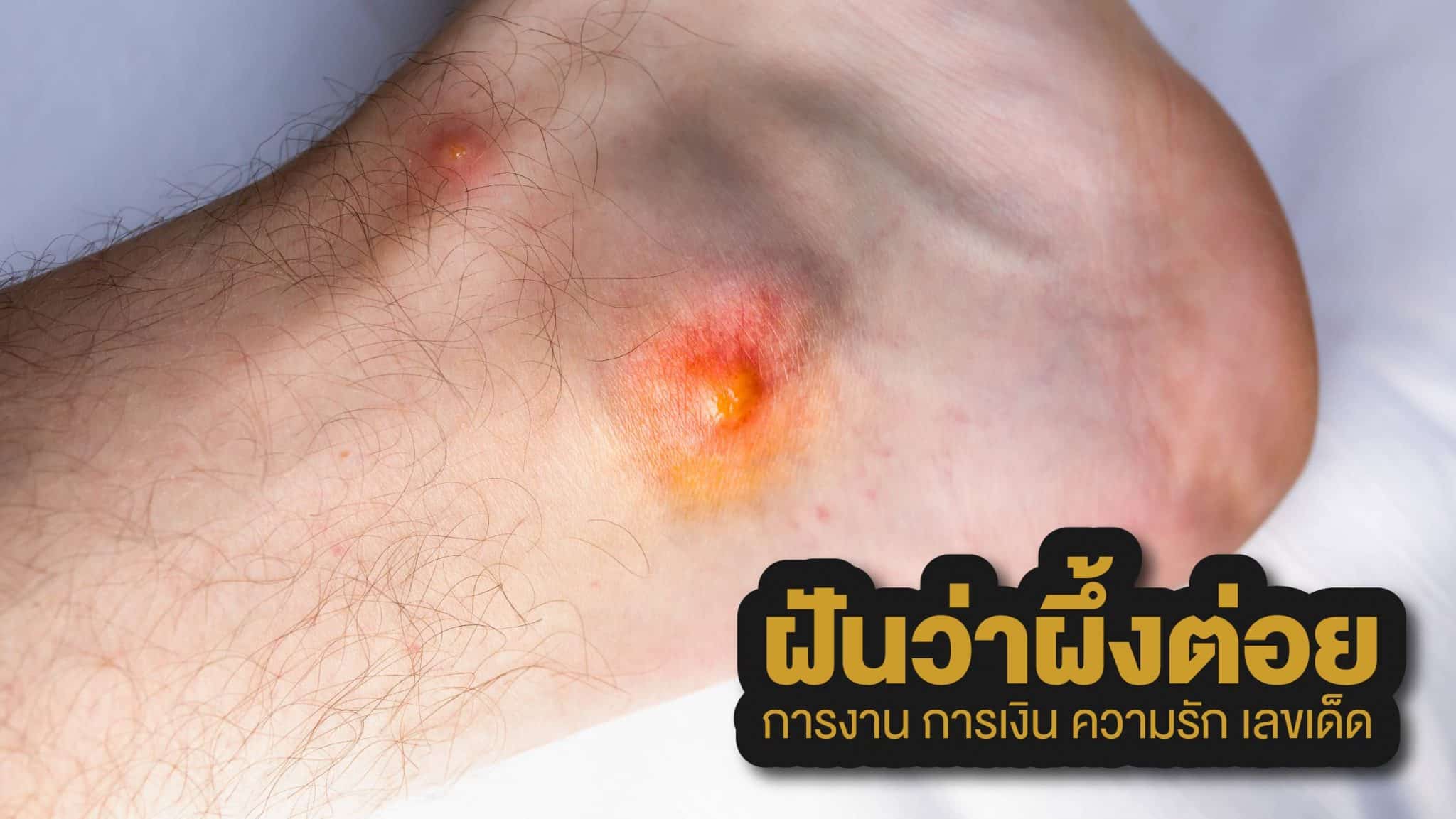 ฝันว่าผึ้งต่อย